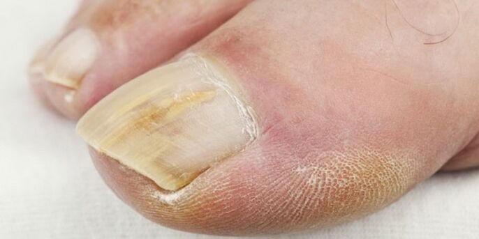 síntomas de fungo das unhas dos pés