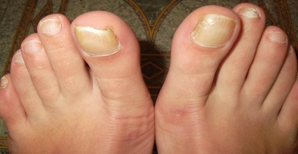 fases iniciais do fungo das unhas do pé