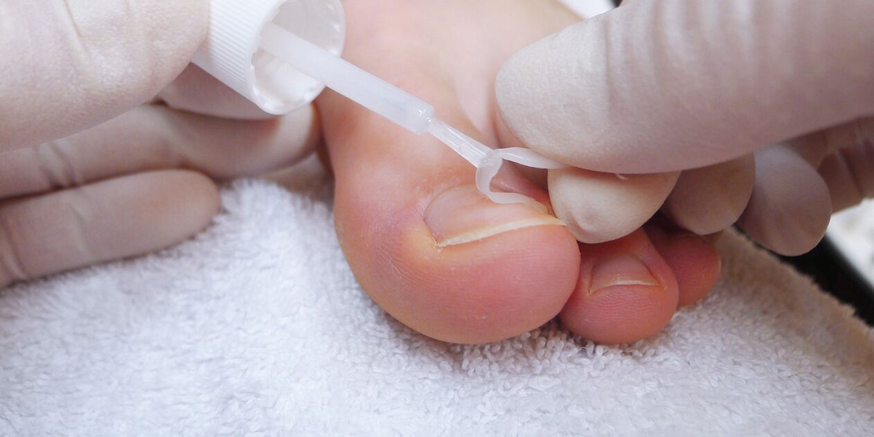 verniz medicinal contra fungos nas unhas