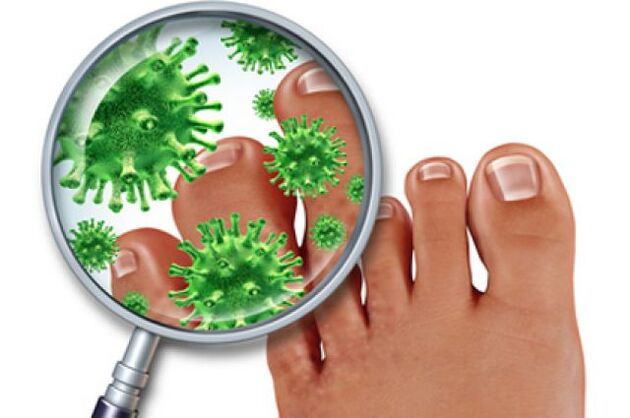 infección por fungos nas unhas dos pés