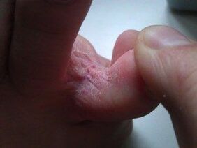 lesións cutáneas entre os dedos dos pés cunha fungo