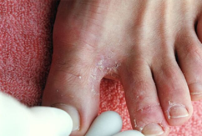 Manifestacións de fungo intertrixinoso entre os dedos dos pés