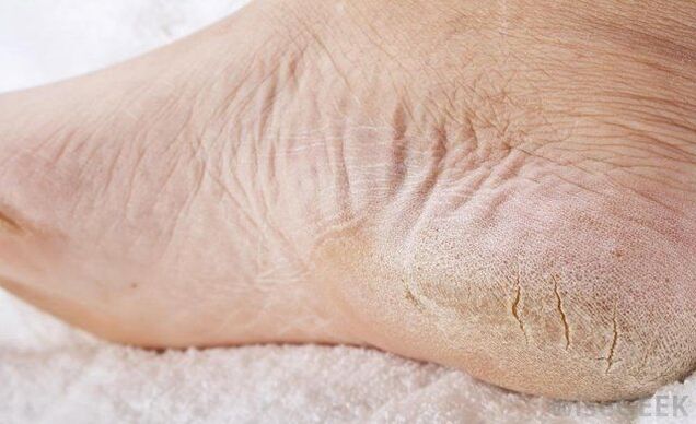 pés secos é un sinal de fungo