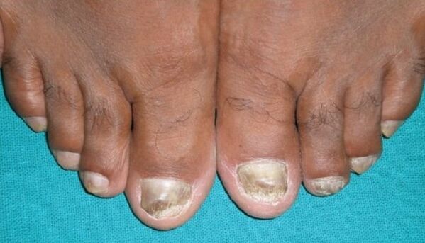 Fungo nas uñas