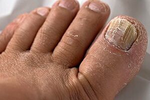Foto do fungo das uñas