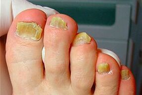 Fungo das uñas