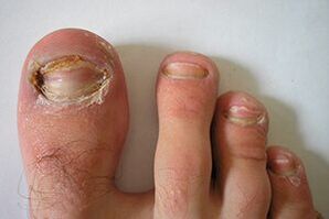 fungo nas uñas