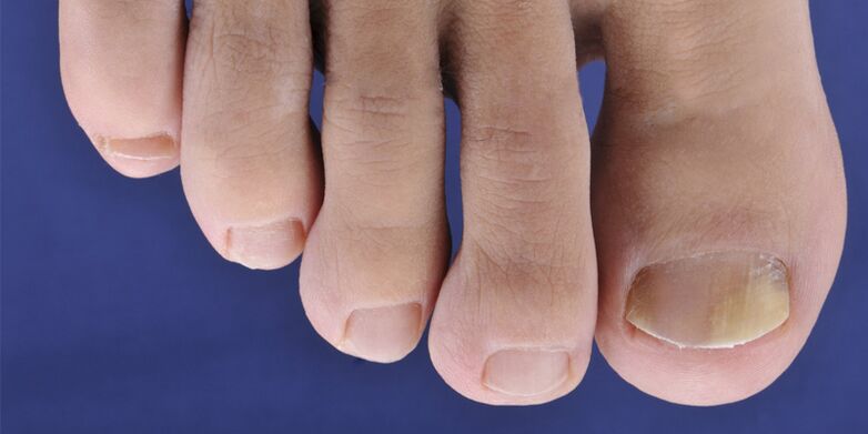 Síntomas da micose da pel e das placas de uñas