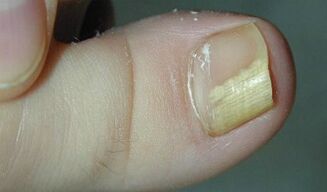 Sinais e síntomas do fungo das uñas