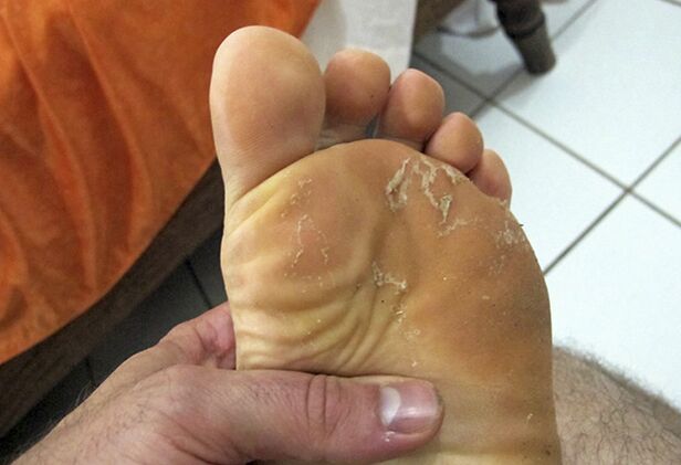 fungo na pel das pernas