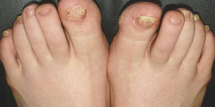 que é o fungo das unhas