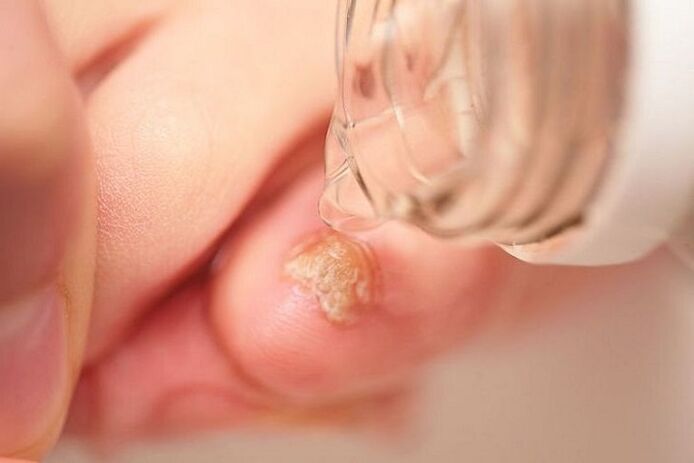 tratamento do fungo das unhas con vinagre
