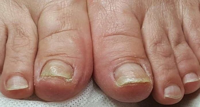 danos nas uñas con fungos nos pés