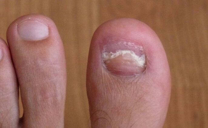 danos na uña do dedo gordo cun fungo